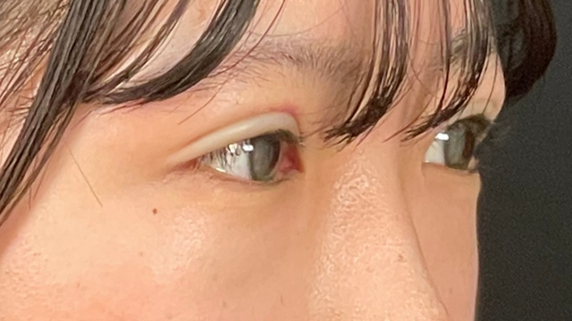 Postoperative Condition Part 1