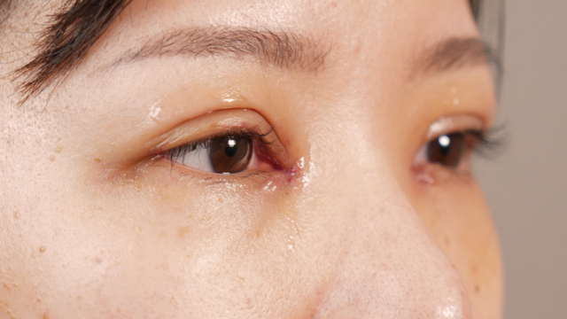 Postoperative Condition Part 1