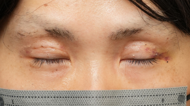 Postoperative Condition Part 1