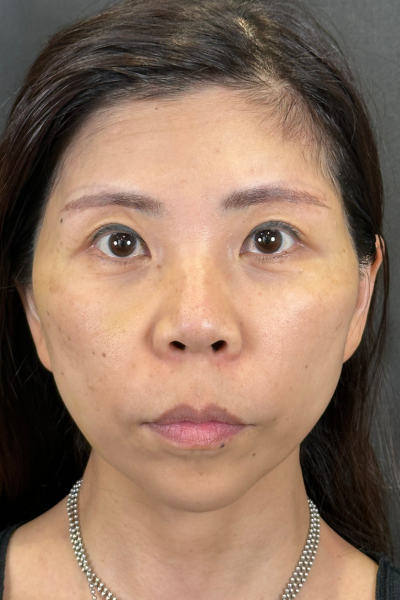 手術前の状態 その1