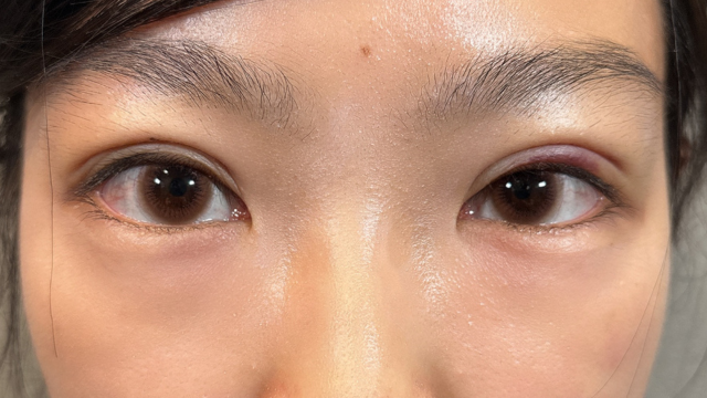 Postoperative Condition Part 1