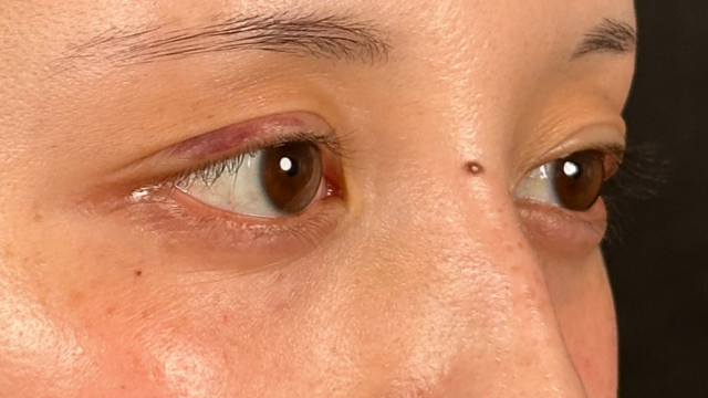 Postoperative Condition Part 1