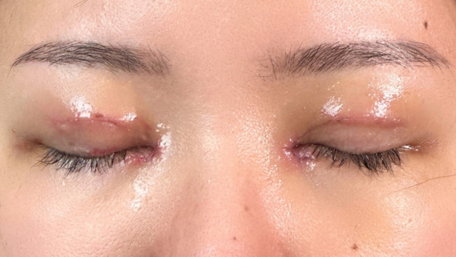 Postoperative Condition Part 1