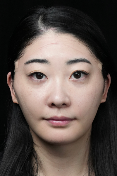 手術前の状態 その1