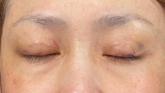 Postoperative Condition Part 1