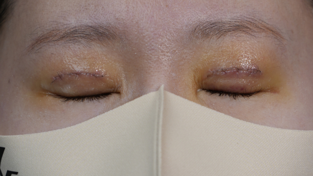 Postoperative Condition Part 1