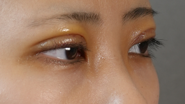 Postoperative Condition Part 1