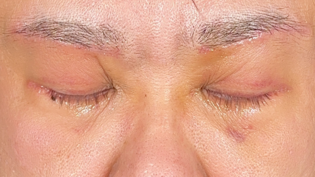 Postoperative Condition Part 1