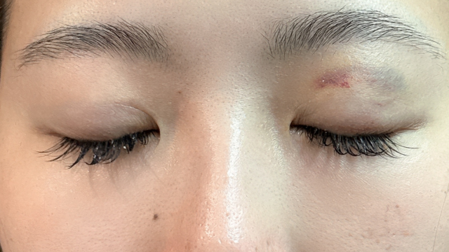 Postoperative Condition Part 1