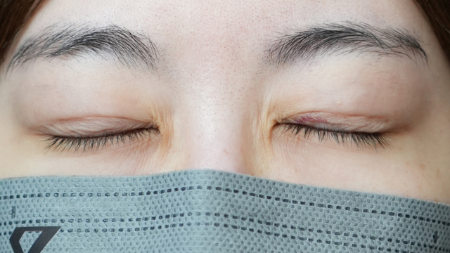 Postoperative Condition Part 1