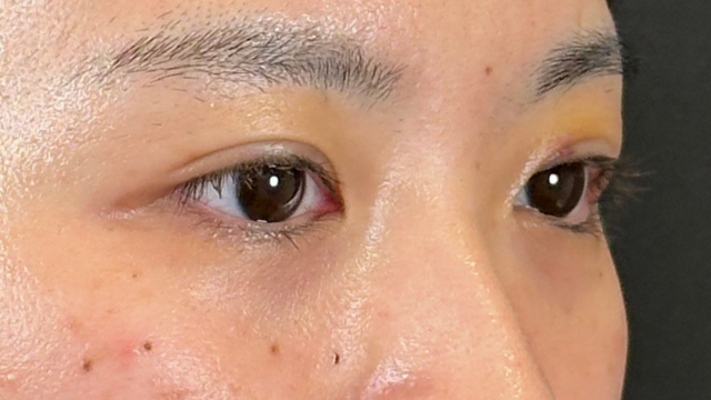 Postoperative Condition Part 1