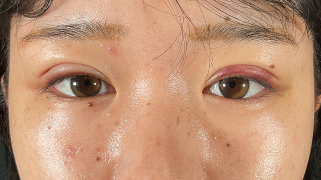 Postoperative Condition Part 1