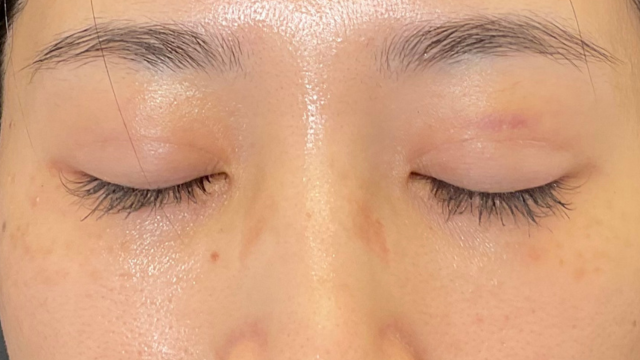 Postoperative Condition Part 1