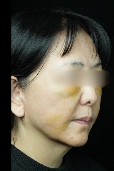 手術前の状態 その1