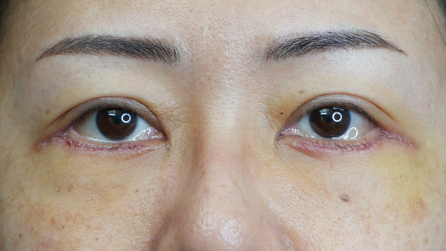 Postoperative Condition Part 1