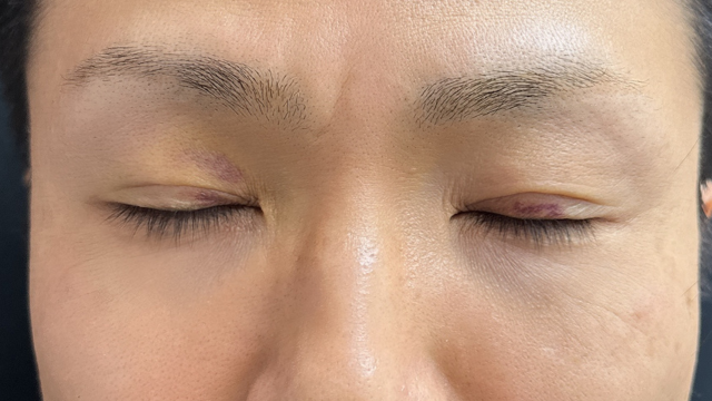 Postoperative Condition Part 1