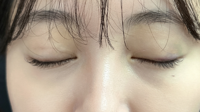 Postoperative Condition Part 1