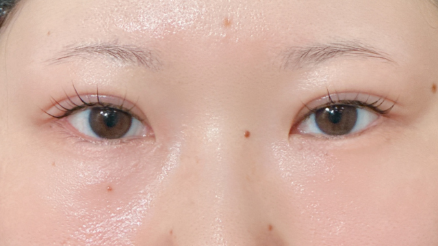 Postoperative Condition Part 1