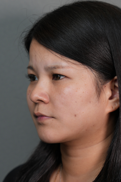 手術前の状態 その1