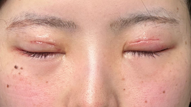 Postoperative Condition Part 1