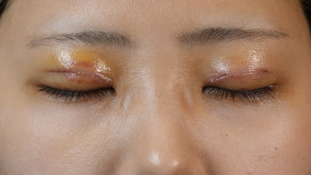 Postoperative Condition Part 1