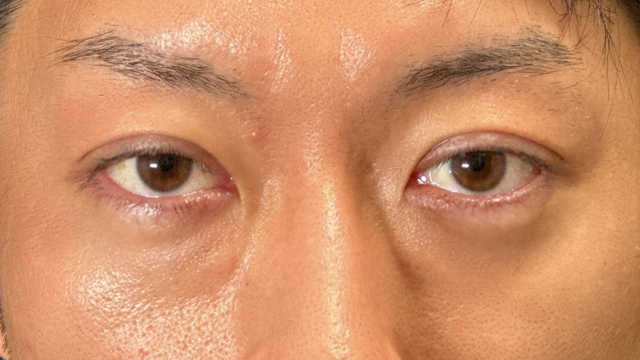 Postoperative Condition Part 1