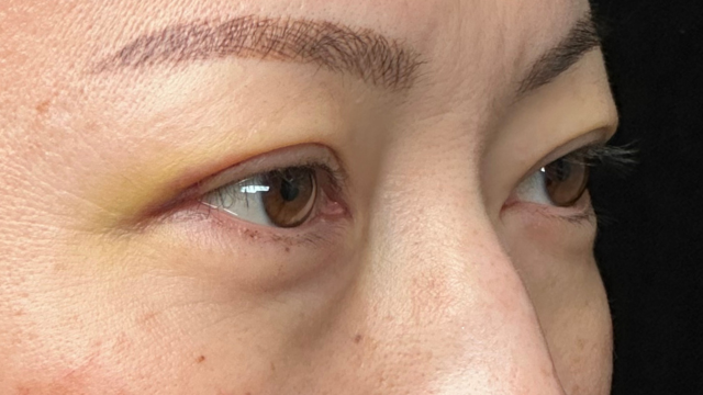 Postoperative Condition Part 1