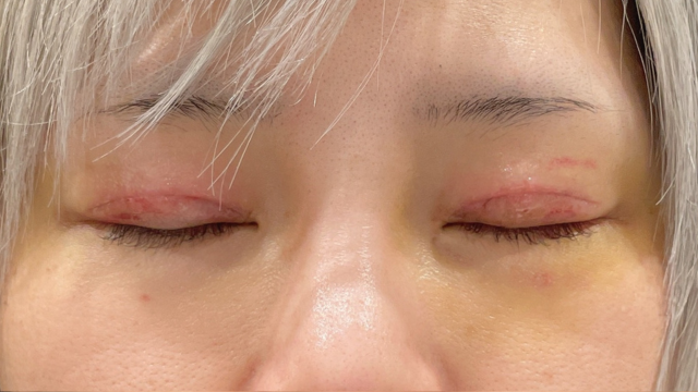 Postoperative Condition Part 1