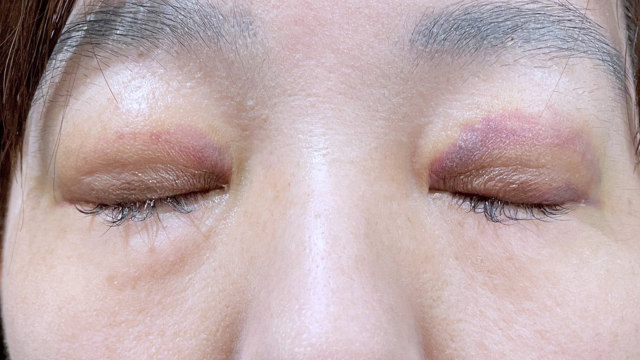 Postoperative Condition Part 1