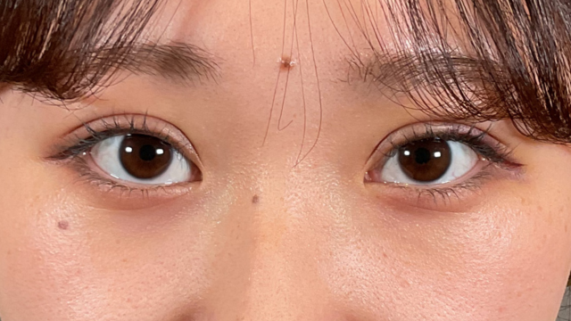 Postoperative Condition Part 1