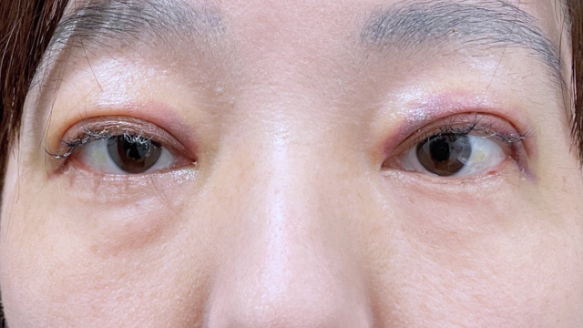 Postoperative Condition Part 1