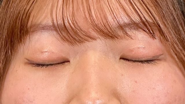 手术前的状态 其一