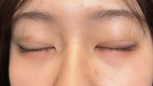 Postoperative Condition Part 1