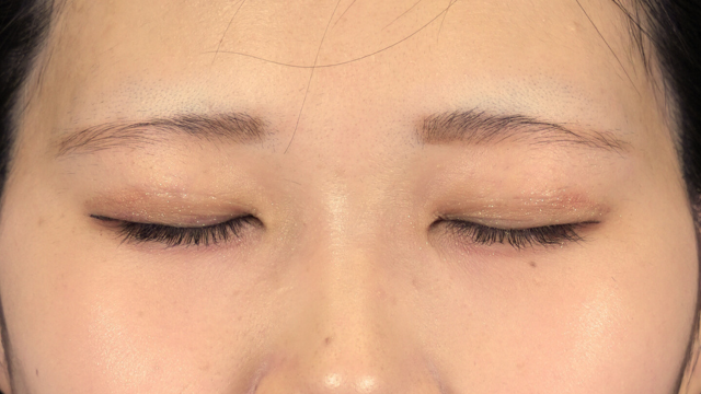 Postoperative Condition Part 1