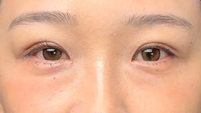 Postoperative Condition Part 1