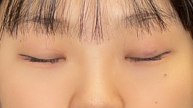 Postoperative Condition Part 1