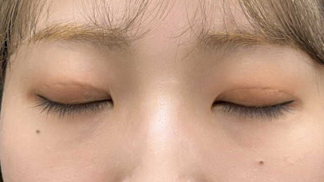 Postoperative Condition Part 1