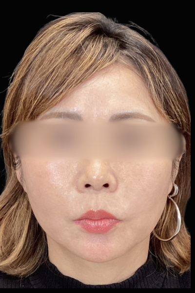 手術前の状態 その1