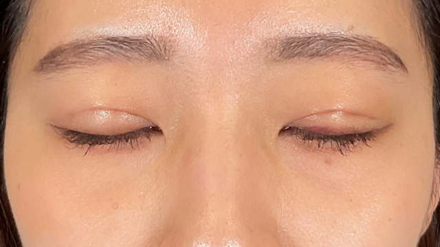 Postoperative Condition Part 1