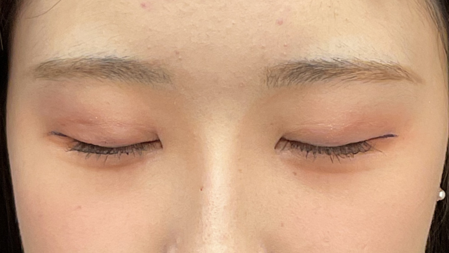 Postoperative Condition Part 1