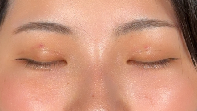 Postoperative Condition Part 1