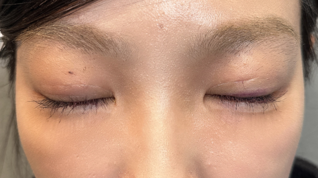 Postoperative Condition Part 1