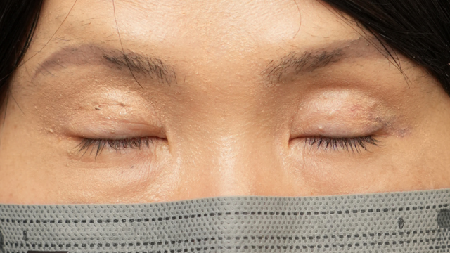 Postoperative Condition Part 1