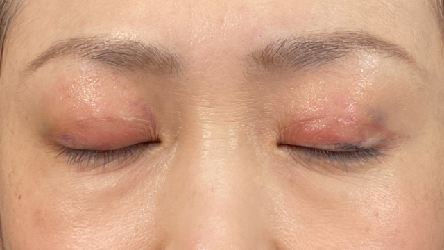 Postoperative Condition Part 1