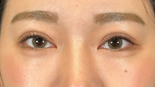 Postoperative Condition Part 1