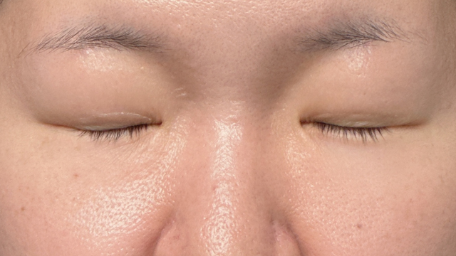 Postoperative Condition Part 1