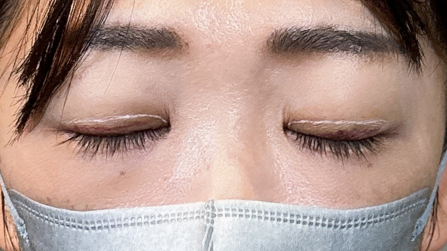 Postoperative Condition Part 1