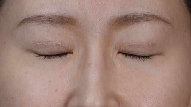 Postoperative Condition Part 1