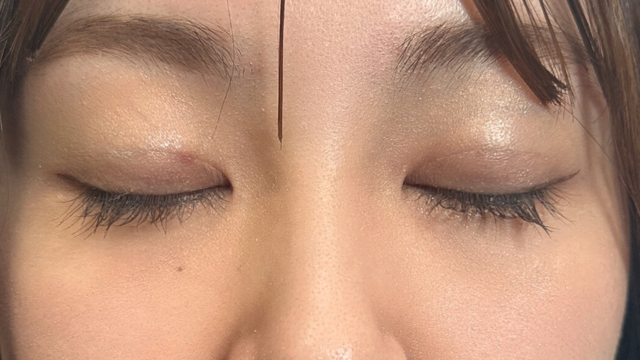 Postoperative Condition Part 1