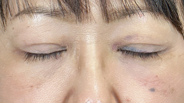 Postoperative Condition Part 1